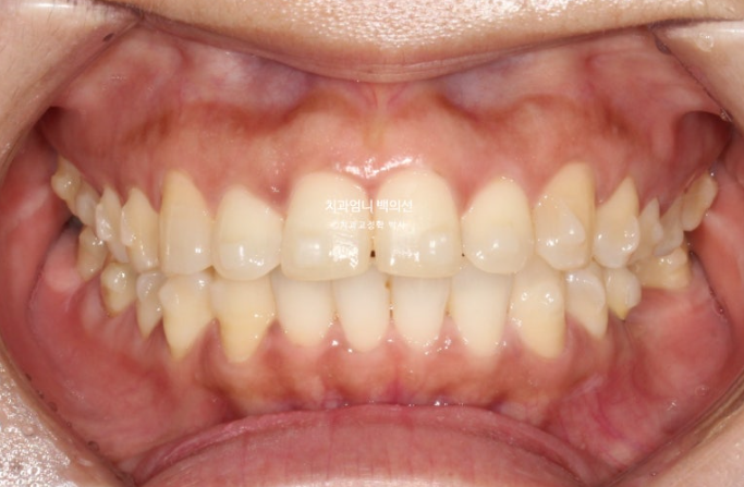 40대 인비절라인 라이트 앞니 벌어짐 뻗침 돌출 치료 관련 이미지 10