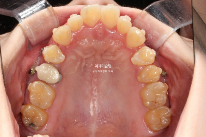 비발치 인비절라인 교정 편측 개방교합 가위교합 돌출 재교정 관련 이미지 10