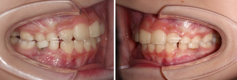 어린이 투명교정 인비절라인 퍼스트 과개교합 교정 후기 관련 이미지 7