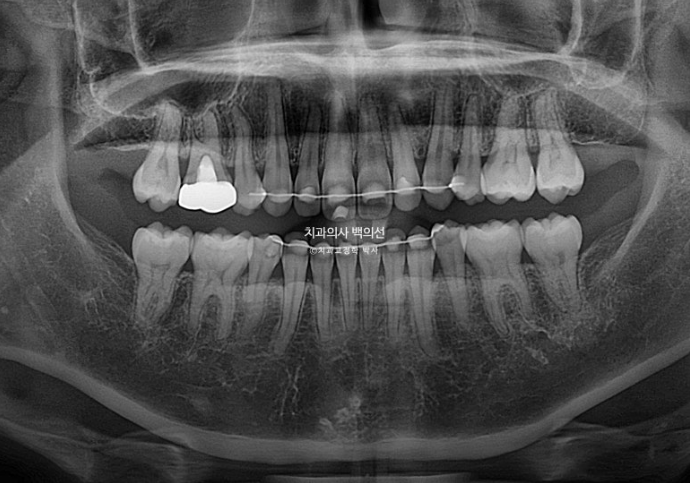 인비절라인 라이트 재교정 발치공간 벌어짐 ? 관련 이미지 15
