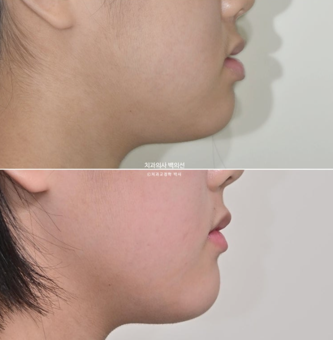 중학생 주걱턱 반대교합 개방교합 덧니 교정 인비절라인 후기 관련 이미지 15