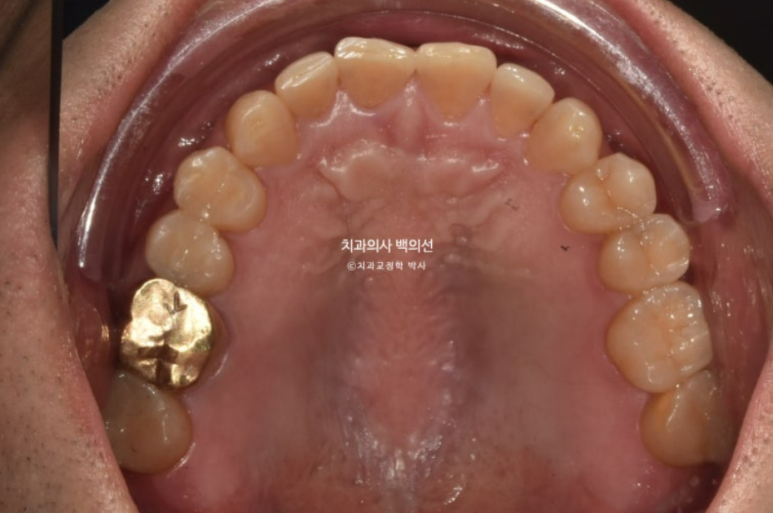 40대 인비절라인 비수술 비발치 주걱턱 비대칭 교정 관련 이미지 4