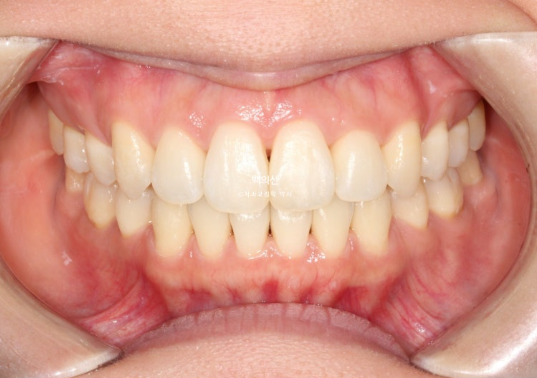 30대 돌출입 덧니 교정 인비절라인 발치교정 후기 관련 이미지 13