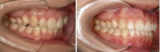 급속 교정 앞니부분교정 치료 무삭제 라미네이트 후기 관련 이미지 12