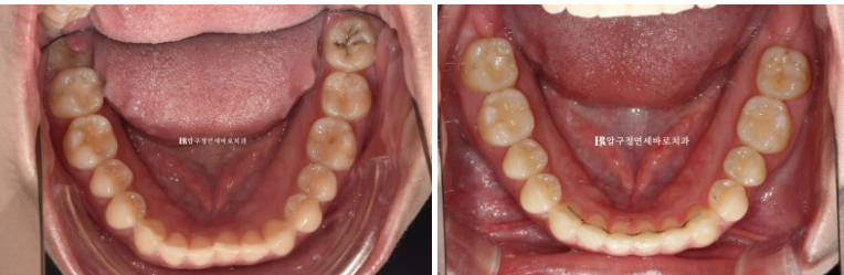 옥니 교정 인비절라인 라이트 옹니 덧니 치료기간 ? 관련 이미지 13