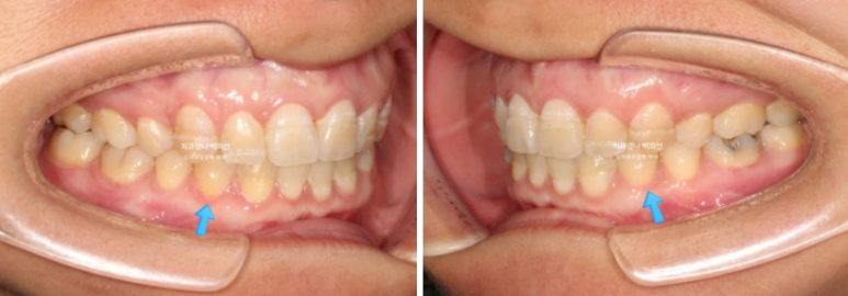 30대 교정 돌출입 교정 덧니 발치교정 치료기간 1년 8개월 관련 이미지 10
