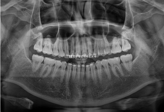 인비절라인 라이트 교정 덧니 이소맹출 반대교합 관련 이미지 14
