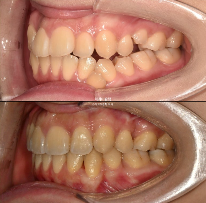 30대 인비절라인 덧니 발치교정 개방교합 치료 관련 이미지 22