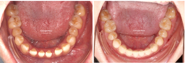 앞니 벌어짐 합죽이 방지 교정 기간 1년 4개월 관련 이미지 12