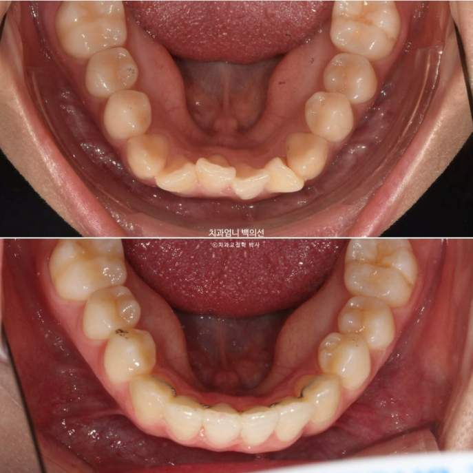 앞니 부분 교정 급속 교정 토끼이빨 MTA 미니튜브 치간삭제 치료기간 9개월 관련 이미지 16
