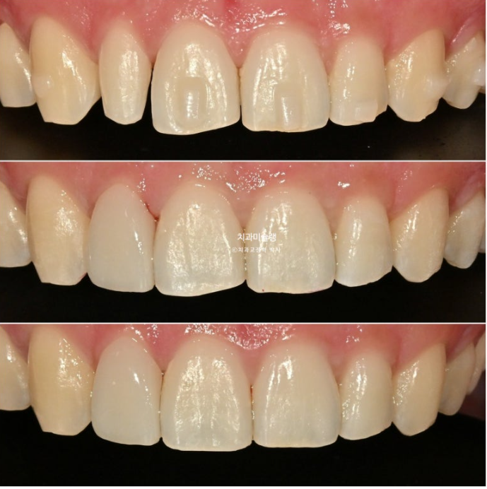 옥니 덧니 교정 왜소치 선천적 결손 3전치 무삭제 라미네이트 인비절라인 교정 관련 이미지 14