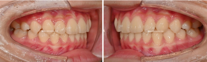 어린이교정 투명교정 인비절라인 퍼스트 후기 관련 이미지 11