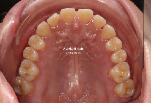 앞니 벌어짐 합죽이 방지 교정 기간 1년 4개월 관련 이미지 3