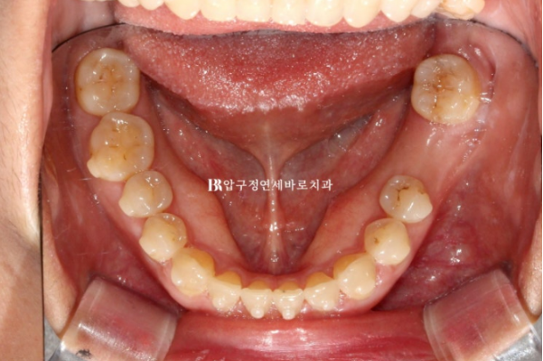Can Gaps Between the Front Teeth Be Treated with No-Prep Veneers Alone? A Real Case Completed with Gelami After Invisalign Lite image 14