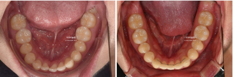 옥니 덧니 교정 왜소치 선천적 결손 3전치 무삭제 라미네이트 인비절라인 교정 관련 이미지 18