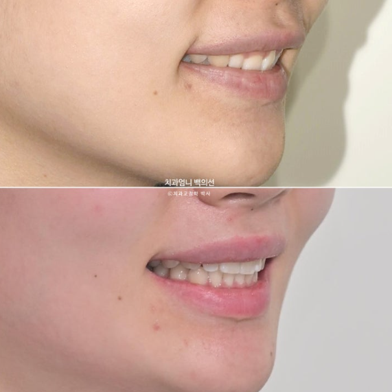 거미스마일 과개교합 교정 잇몸돌출 잇몸 비대칭 관련 이미지 19