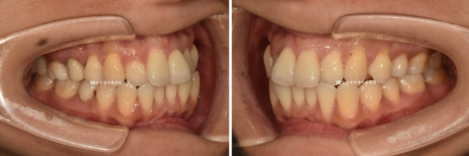 30대 토끼이빨 교정 반대교합 앞니 부분교정 후기 관련 이미지 3