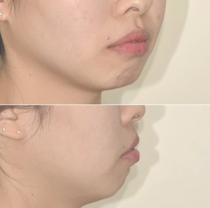 돌출입 인비절라인 발치교정 거미스마일 잇몸미소 잇몸돌출 입술부전증 무턱 재교정 관련 이미지 5