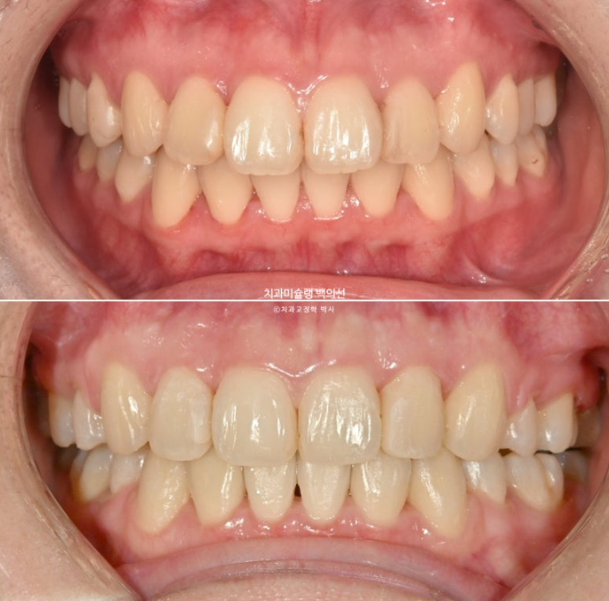 돌출입 인비절라인 발치교정 거미스마일 잇몸미소 잇몸돌출 입술부전증 무턱 재교정 관련 이미지 18