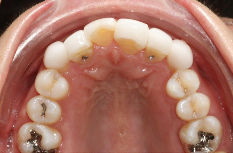 50대 중년교정 무삭제 라미네이트 중년 부분교정 후기 관련 이미지 5