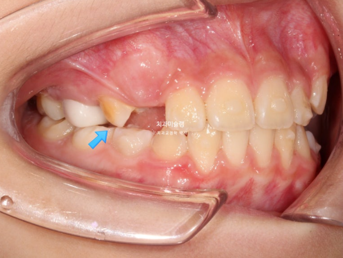 어린이 돌출입 교정 무턱 투명교정 인비절라인 퍼스트 관련 이미지 9