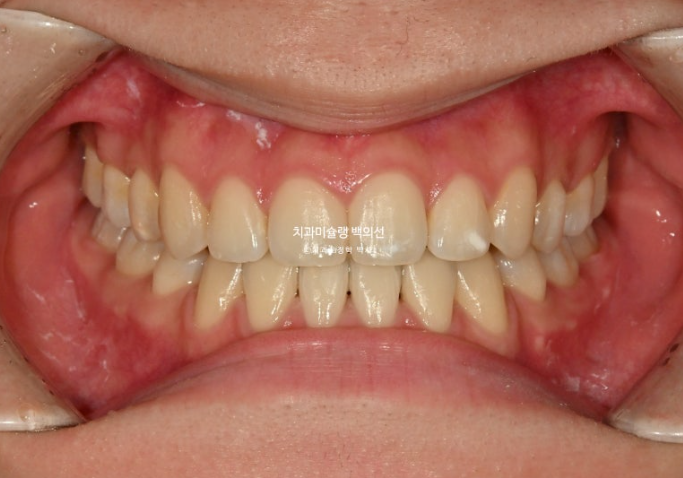 비수술 주걱턱 비대칭 발치 교정 결손치 반대교합 클리피씨 치료기간 1년 11개월 관련 이미지 10