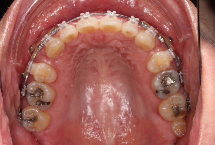 Extraction Orthodontics with Clippy-C for Protruding Mouth, Gum Smile, Gummy Smile Correction, and Treatment for a Recessed Chin image 9