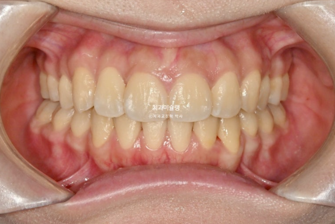 30대 인비절라인 덧니 발치교정 개방교합 치료 관련 이미지 17