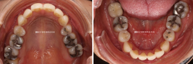 블랙트라이앵글 없애는 교정 가능할까요? 재교정 단기교정 후기 관련 이미지 3