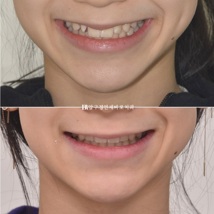 인비절라인라이트 덧니 과개교합 교정 치료기간 9개월 관련 이미지 12