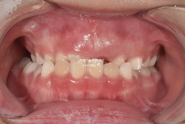 어린이 비대칭 반대교합 주걱턱 인비절라인 퍼스트 프리올소 성장 교정 관련 이미지 2