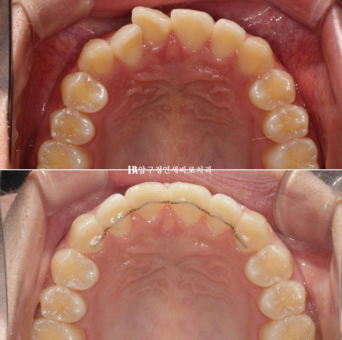 압구정 교정치과 덧니 부분교정 단기교정 후기 관련 이미지 10