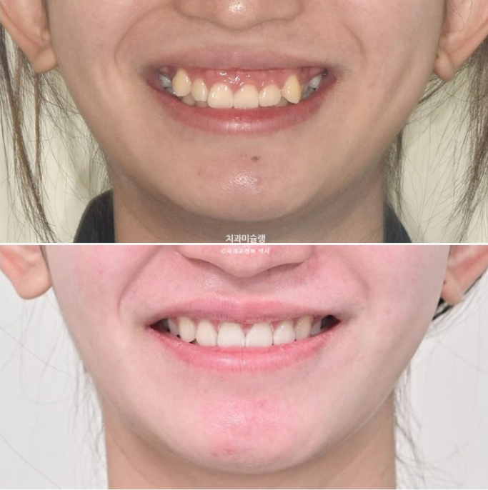 잇몸미소 거미스마일 치료 옥니 교정 잇몸성형 후기 관련 이미지 18