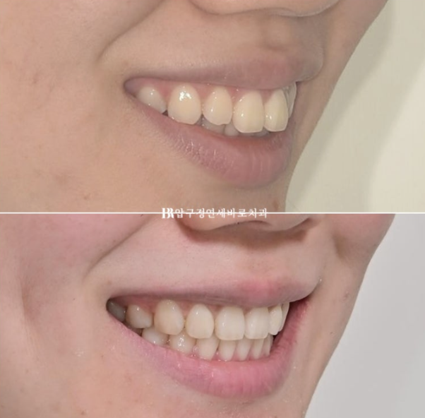 Gummy Smile Correction Review | Natural Improvement of Gummy Smile and Buccal Corridors Through Extraction Treatment for Protruding Teeth image 19