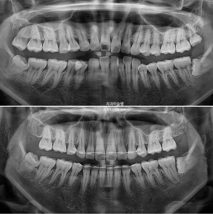 돌출입 덧니 발치 교정 인비절라인 교정 후기 관련 이미지 31