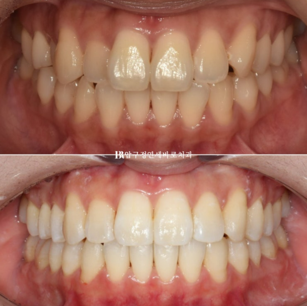9-Month Invisalign Lite Review|Real Case Improving a Crossbite and Crooked Teeth Together image 1