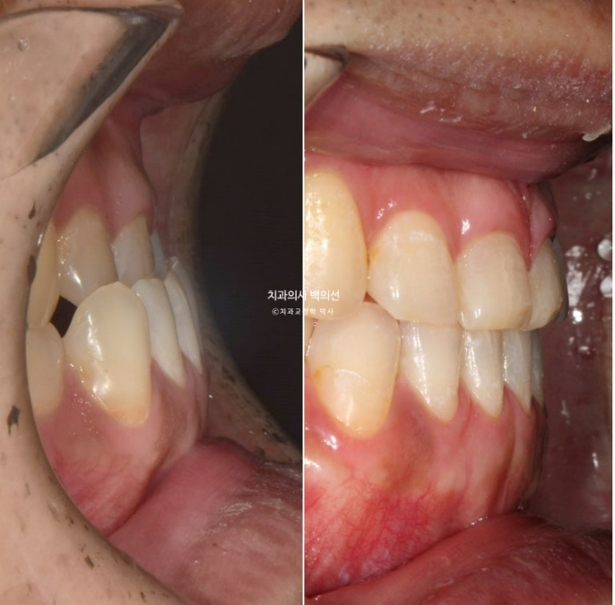 30대 주걱턱 비수술 비발치 교정 후기 관련 이미지 13