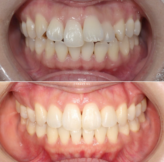 30대 돌출입 덧니 교정 인비절라인 발치교정 후기 관련 이미지 17