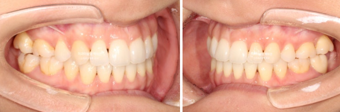 인비절라인 익스프레스 재교정 블랙트라이앵글 치간 삭제 치료기간 6개월 재제작 1회 관련 이미지 12