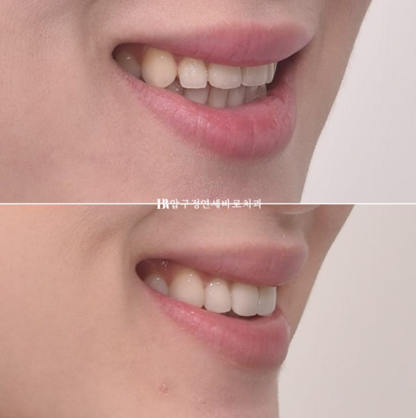 Before and After Non-Prep Veneers: Improving Gaps Between the Front Teeth and the Smile Line Together image 14