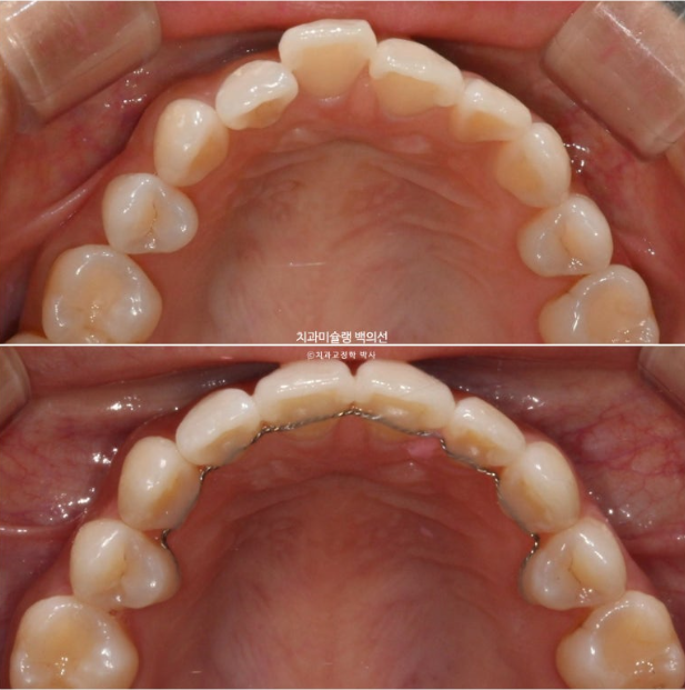 인비절라인 익스프레스 재교정 블랙트라이앵글 치간 삭제 치료기간 6개월 재제작 1회 관련 이미지 15