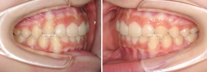 과개교합 인비절라인 모더레이트 컴프레헨시브 중심선 토끼이빨 관련 이미지 12