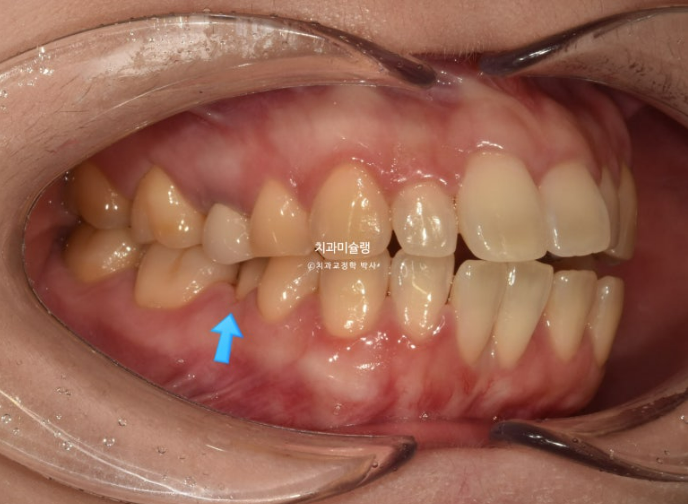 비발치 인비절라인 교정 편측 개방교합 가위교합 돌출 재교정 관련 이미지 3