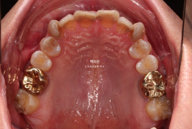 Treatment Review: No-Prep Laminate for Tetracycline-Stained Teeth image 6