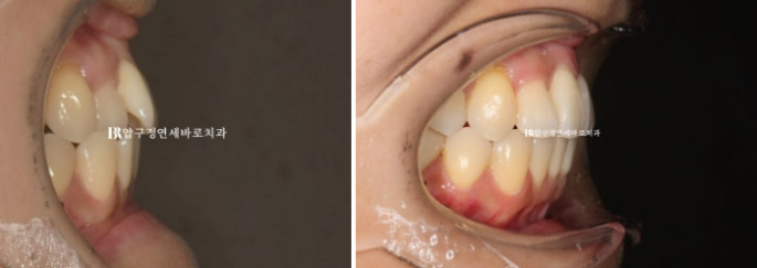 토끼이빨도 부분교정이 가능할까요? 30대 앞니 반대교합 6개월 치료 사례 관련 이미지 8