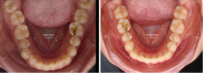 거미스마일 과개교합 교정 잇몸돌출 잇몸 비대칭 관련 이미지 13