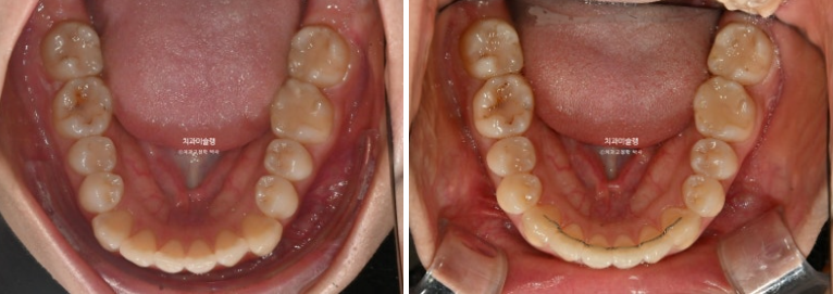 인비절라인 라이트 반대교합? 덧니 중심선 치간삭제 치료 관련 이미지 14