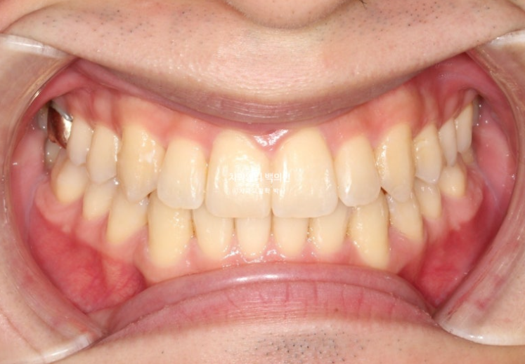 인비절라인 비발치 앞니 돌출 교정 치료기간 2년 5개월 관련 이미지 9