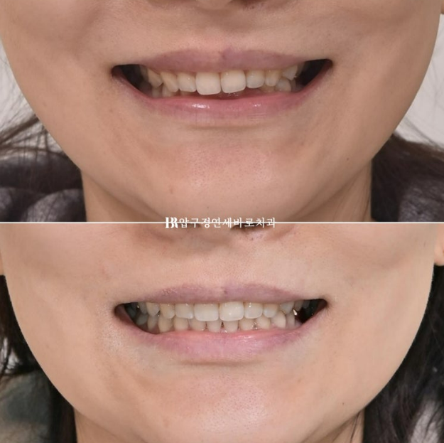 인비절라인 캔팅 교정 과개교합 교정 임플란트 재교정 관련 이미지 14