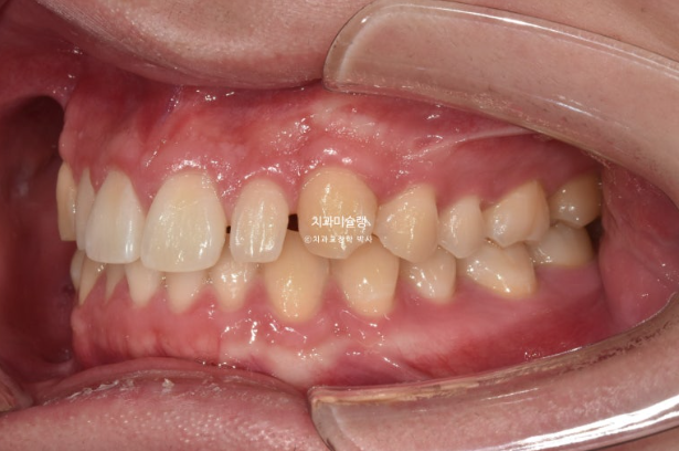 비대칭 비발치 거미스마일 잇몸미소 중심선 가위교합치료 무삭제 라미네이트 관련 이미지 6